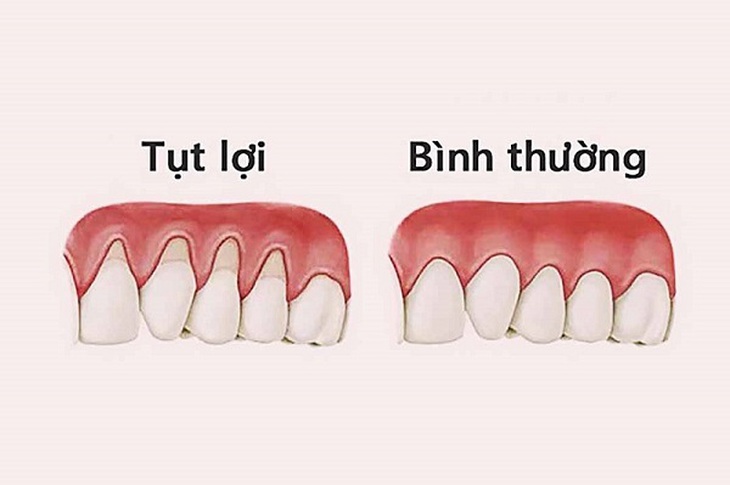 Hình ảnh lợi bị tụt.